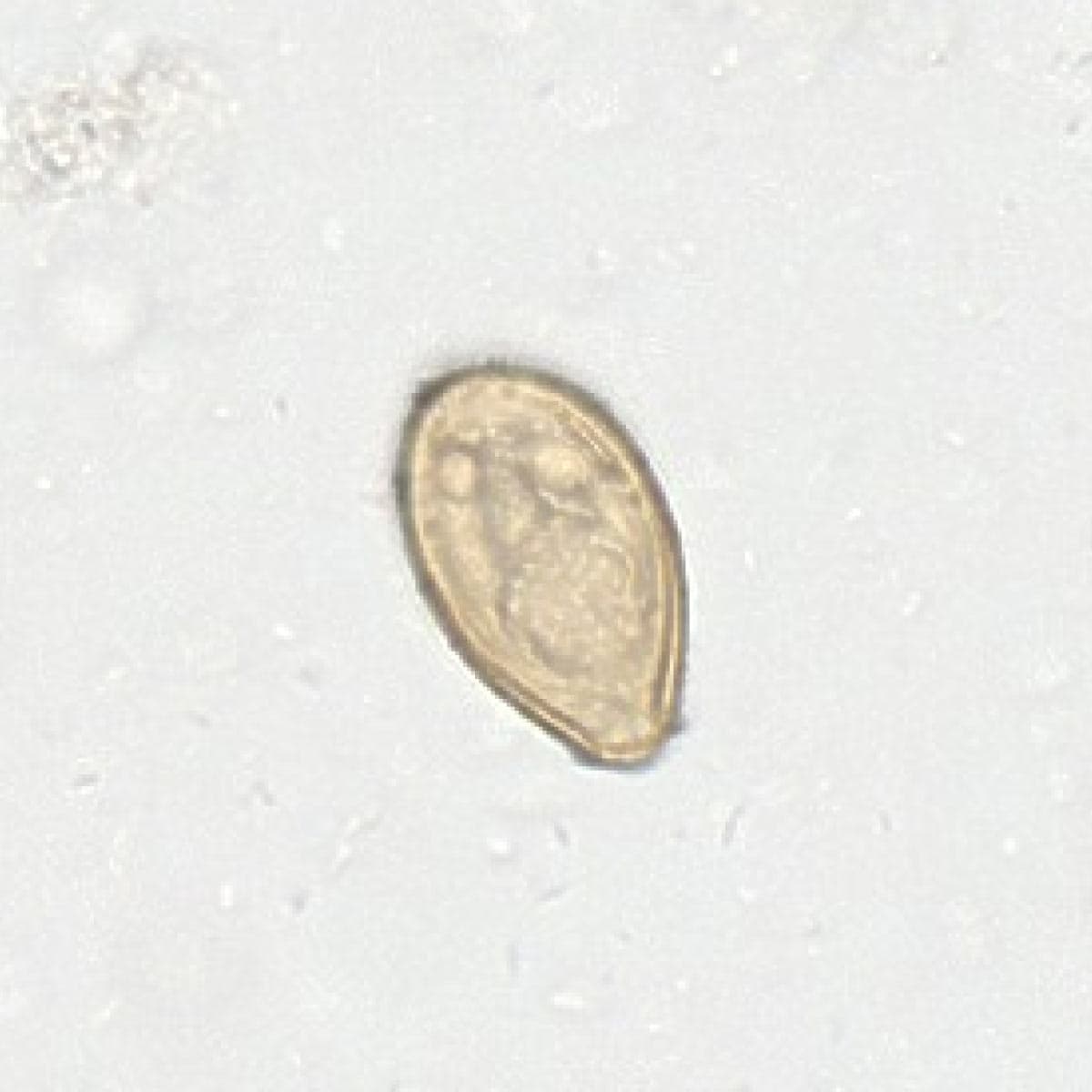 ParaScout AI microscopic image showing a Clonorchis sinensis egg with operculum, AI detection box, automated measurement (31x16 µm), and 93% confidence score.